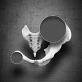 Abscission iii